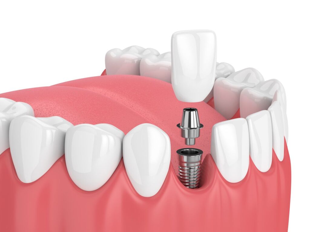 Dental Implants in Austin, TX