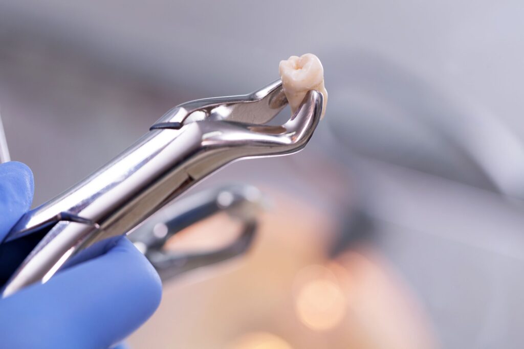 Tooth Extraction in Austin, TX