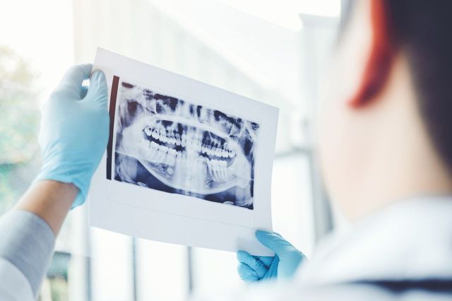 Why Do I Need a Dental X-Ray
